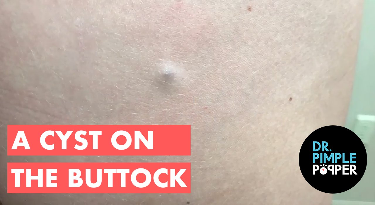 A Cheeky little Cyst... Dr Pimple Popper