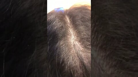 Girls scalp