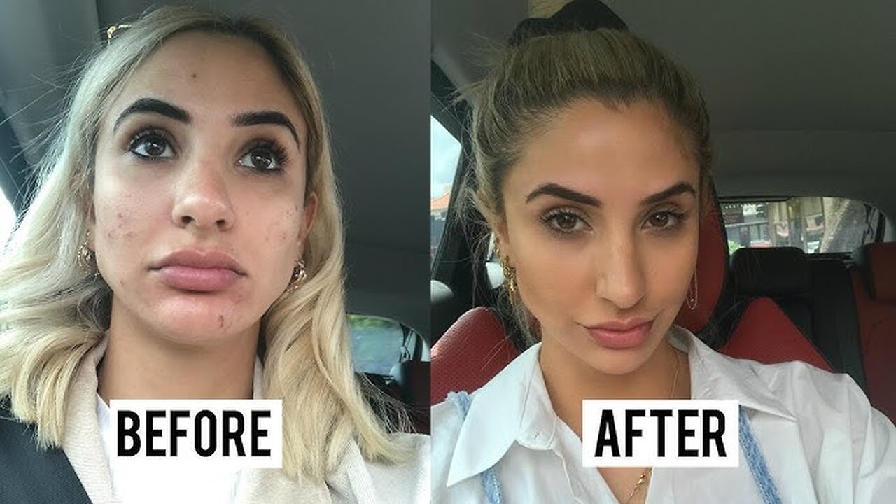 Skincare Routine: How I Got Rid Of Acne In 1 Week