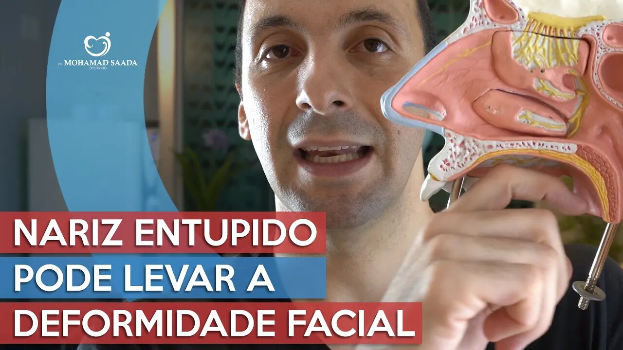 Nariz Entupido Pode Levar a Deformidade Facial e Dentaria