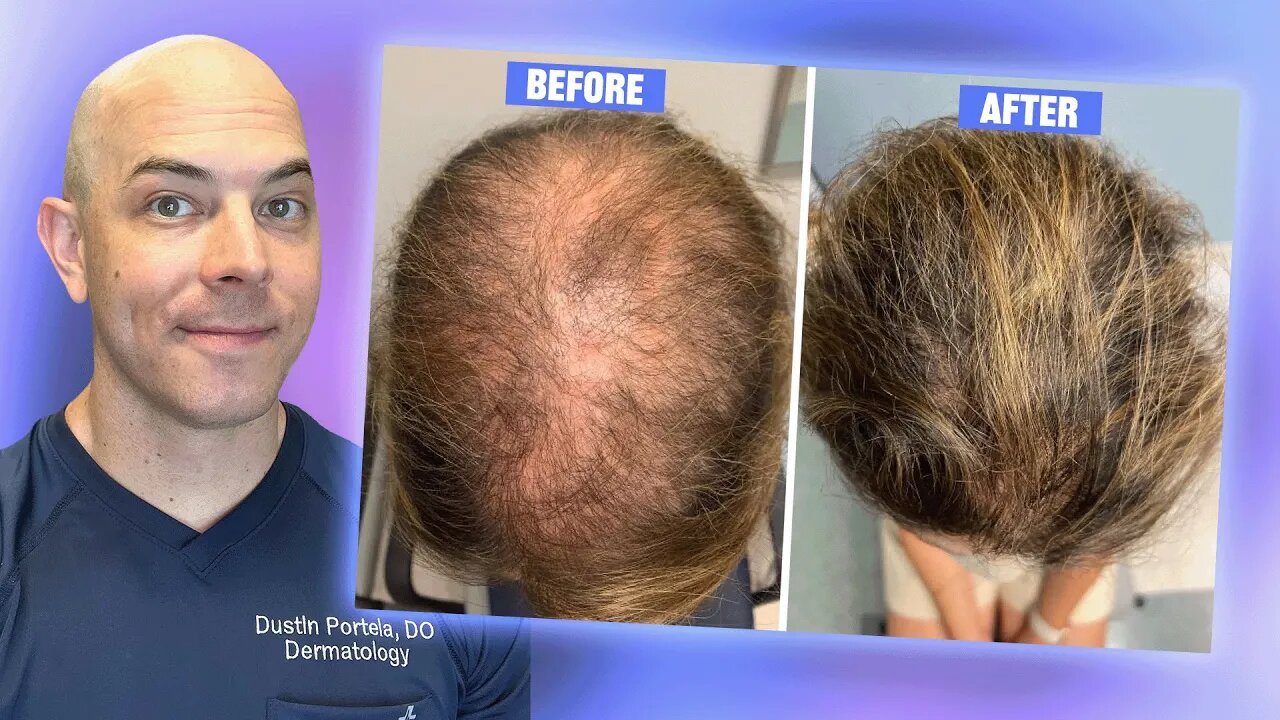 Oral Minoxidil For Hair Loss? What You Need to Know