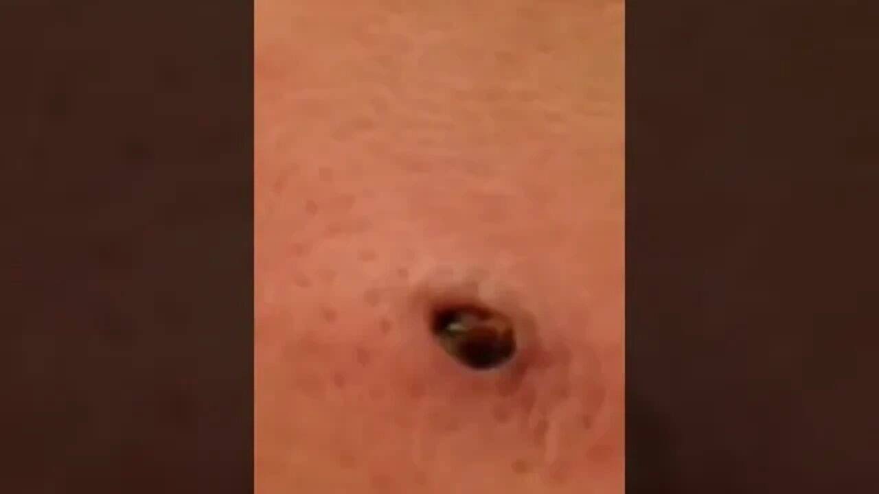 Much better than excepted - Huge Ingrown Blackhead