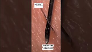 5 minutes of Ingrown Hair Removal