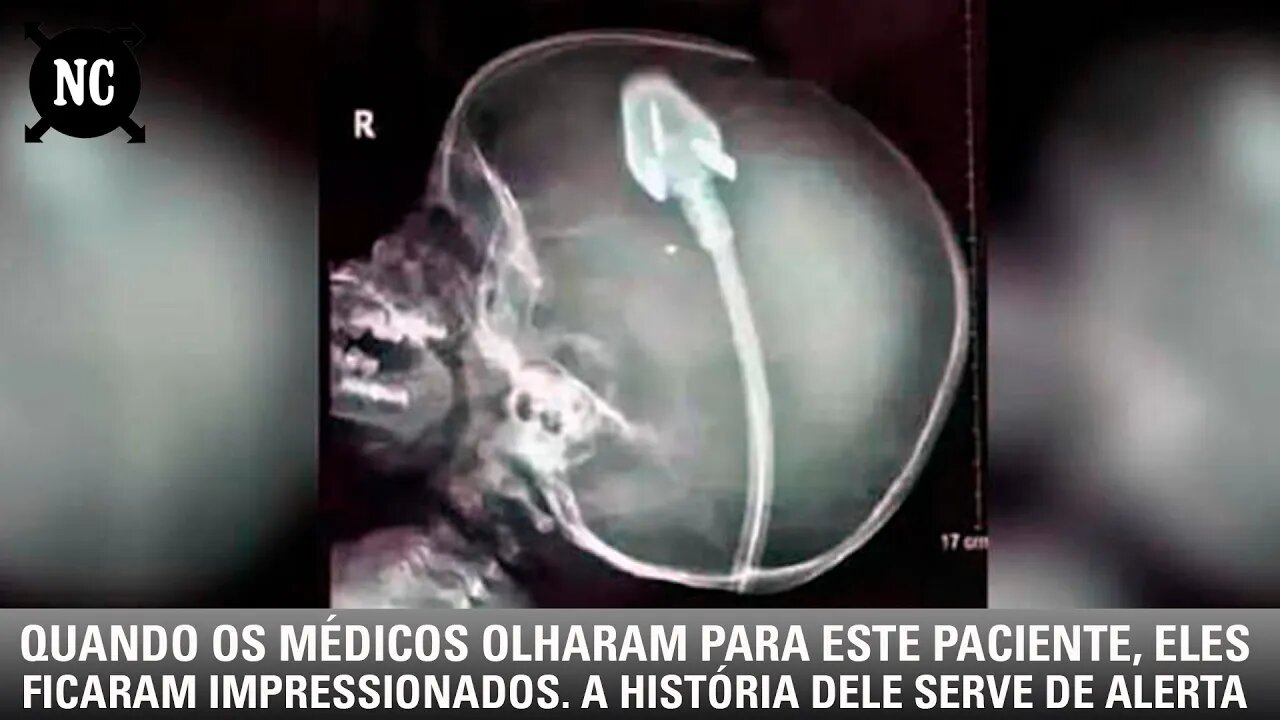 Quando os médicos olharam para este paciente, eles ficaram impressionados. A história é um alerta
