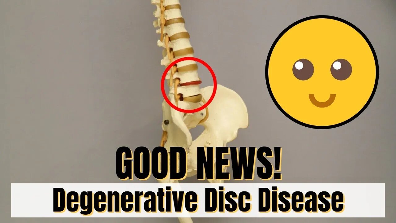 Good News!! If diagnosed with DDD (Degenerative Disc Disease) Must Know This!!