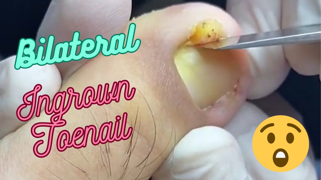 Bilateral Ingrown Toenail