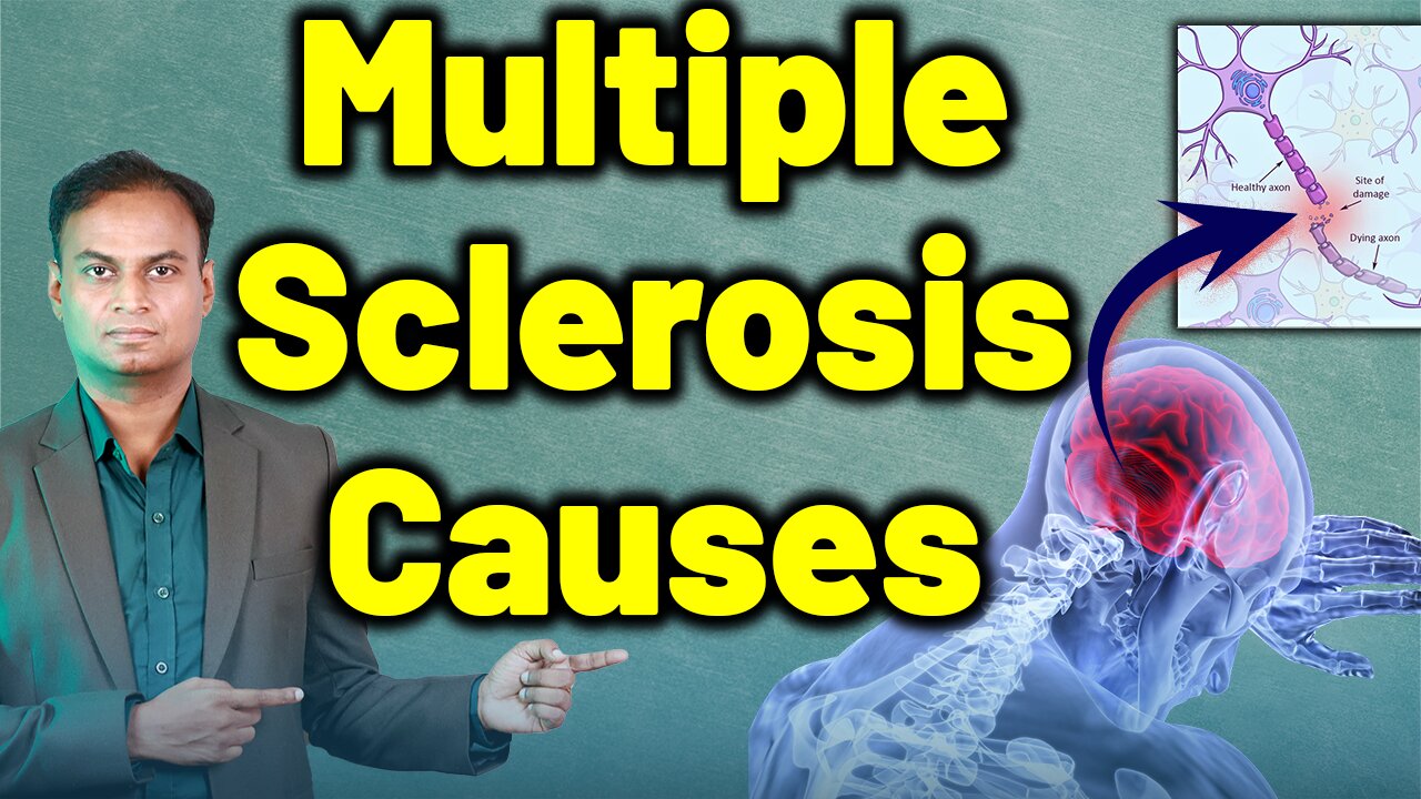 What Are The Causes of Multiple Sclerosis and Homeopathy Treatment & Cure | Dr. Bharadwaz