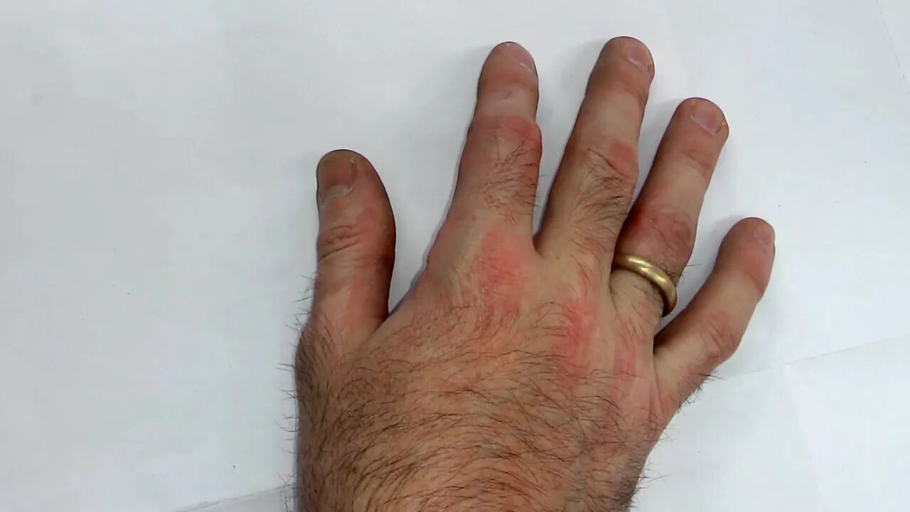 Как снять кольцо с опухшего пальца
