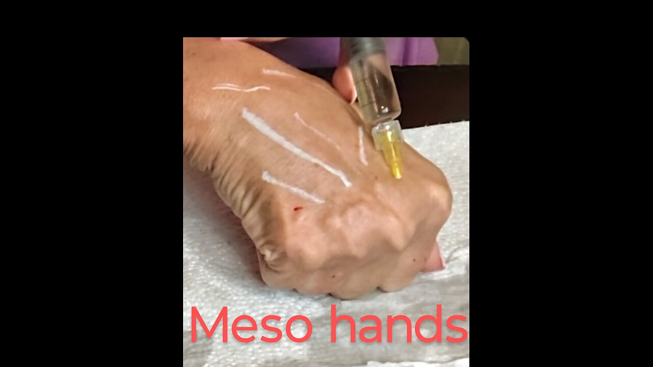 Regenovue PN meso hands restore rejuvenation Meamoshop