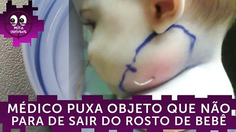 Médico puxa objeto que não para de sair do rosto de bebê