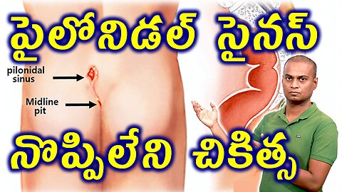 టిష్షు పేపర్ వాడుతున్నారా పైలోనిడల్ సైనస్ ప్రమాదం | Pilonidal Sinus Cyst Treatment | డా. భరద్వాజ్