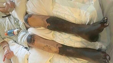 Amateur footballer Levi Dewey (21) has both of his legs amputated & multiple organ failure