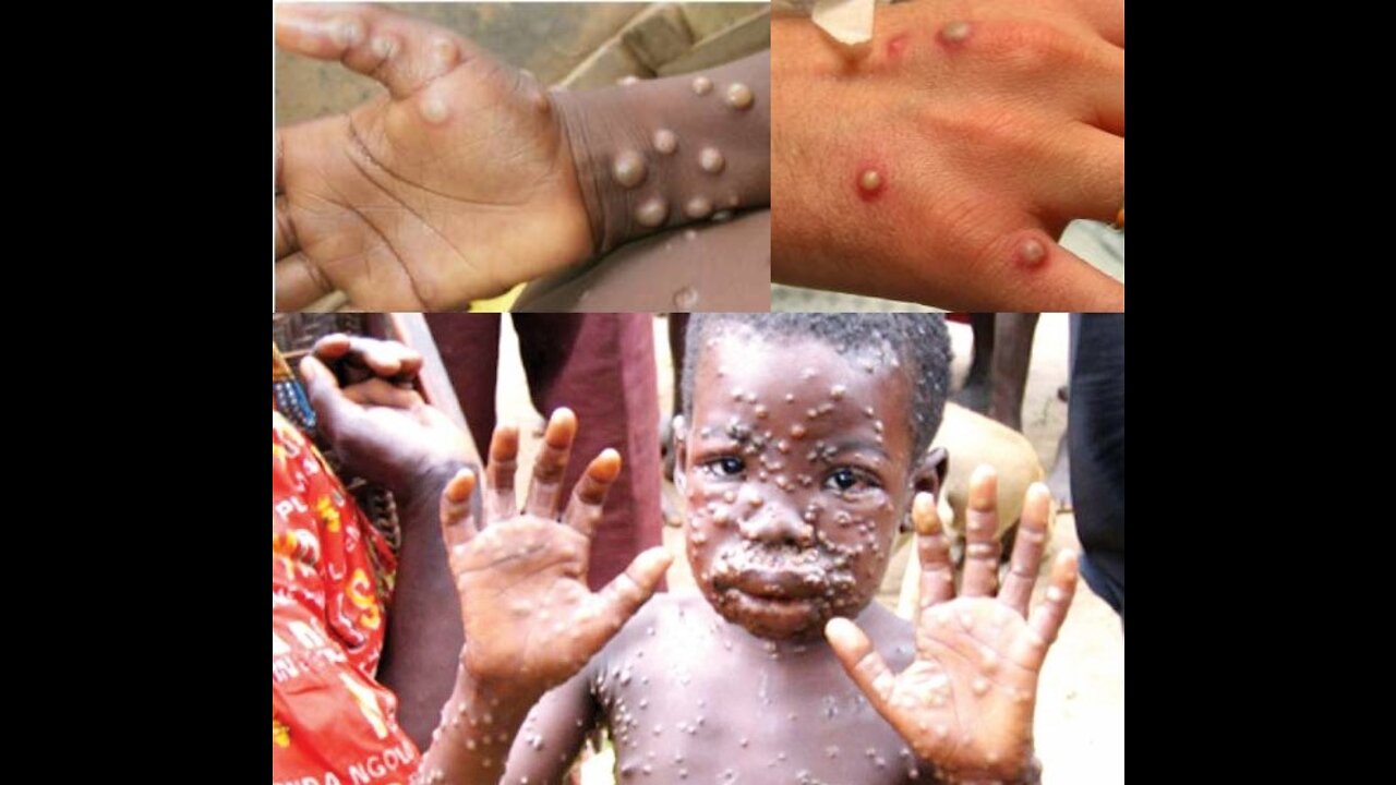 Concern grows as more countries detect monkeypox