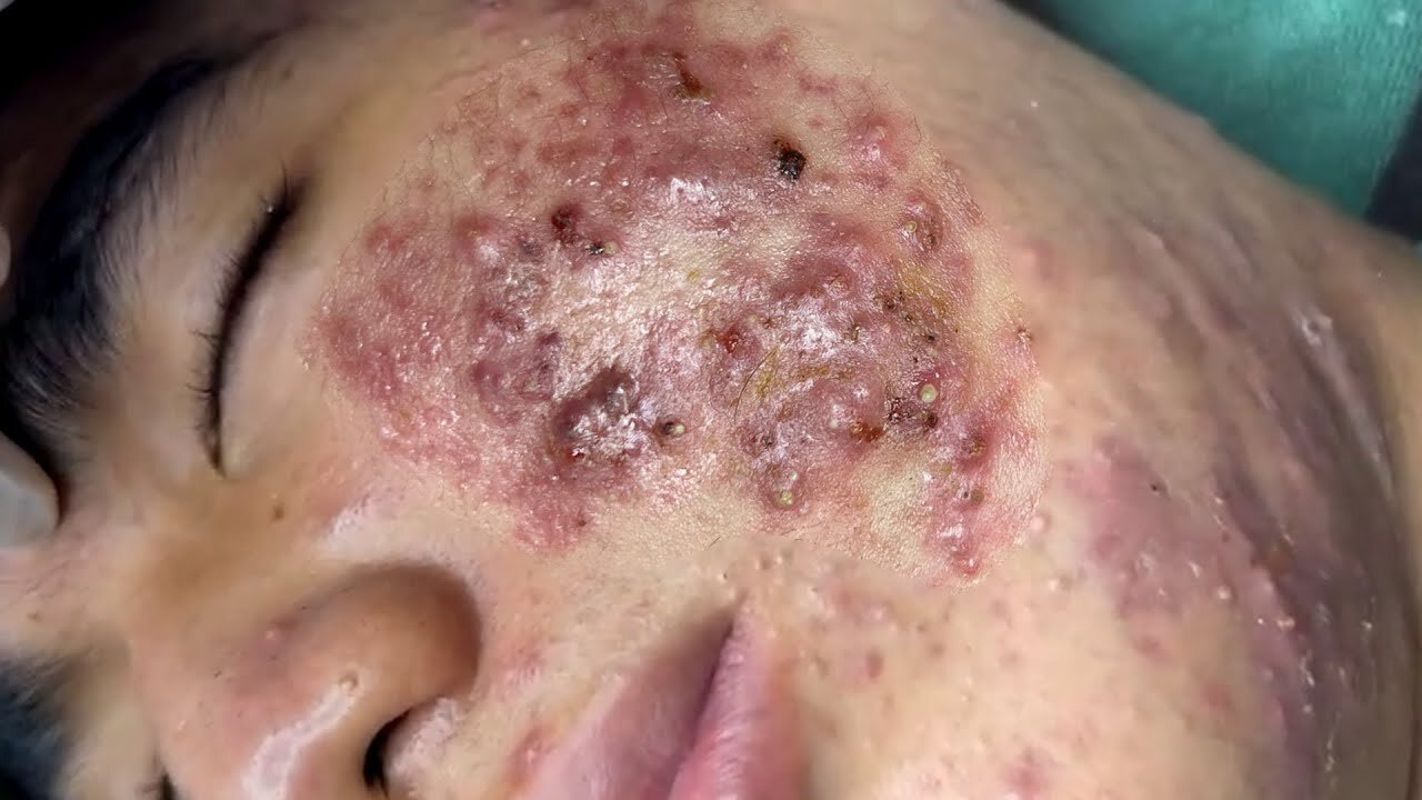 Big Cystic Acne Blackheads Extraction Blackheads & Milia, Whiteheads Removal Pimple Popping 12