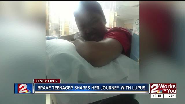 Tulsa girl and her mother use her fight with Lupus to educate Green Country