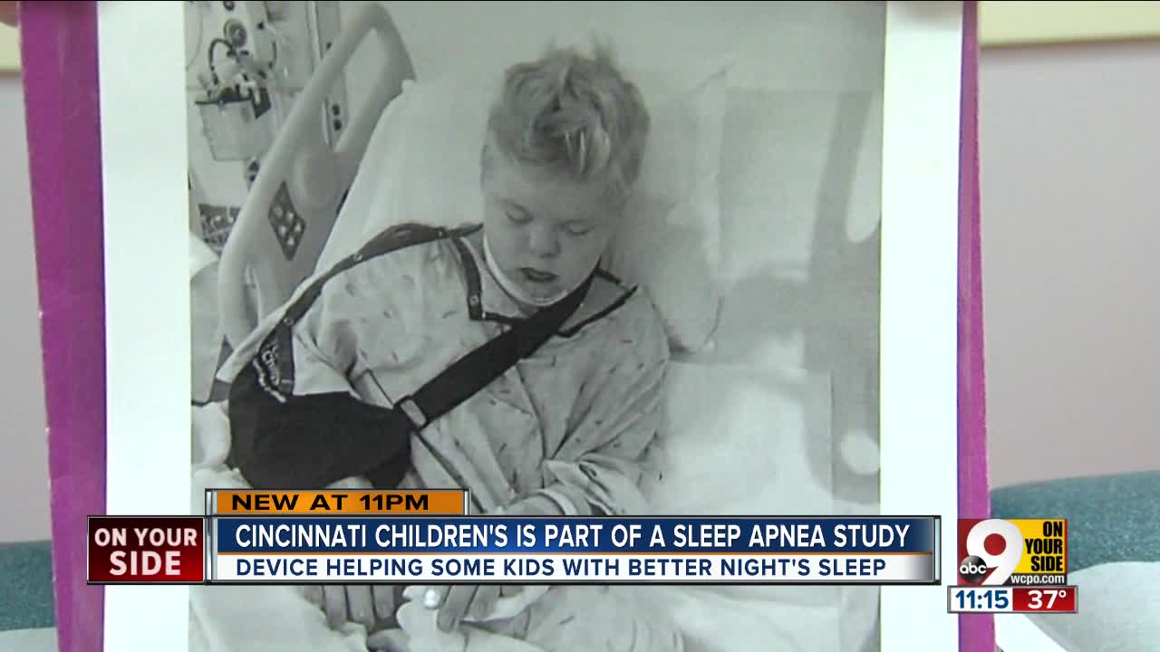 Solving sleep apnea in Down syndrome kids