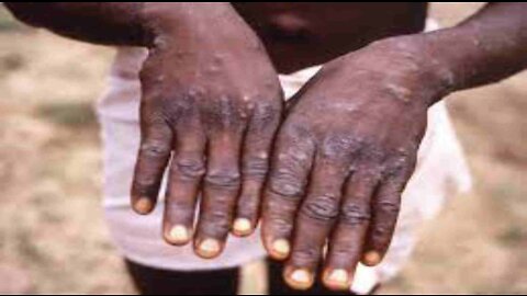 More Than 700 Monkeypox Cases Globally, 21 in US CDC