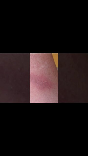 I Burned Myself #Shorts 😬