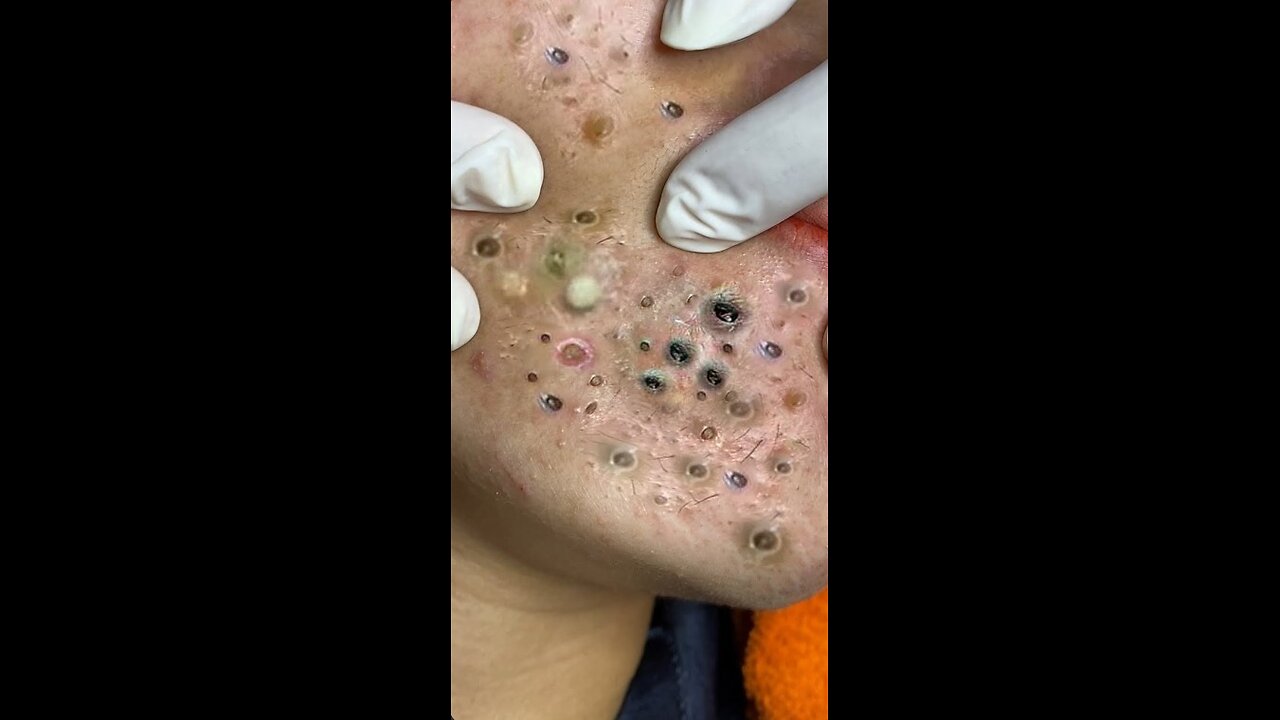 blackhead