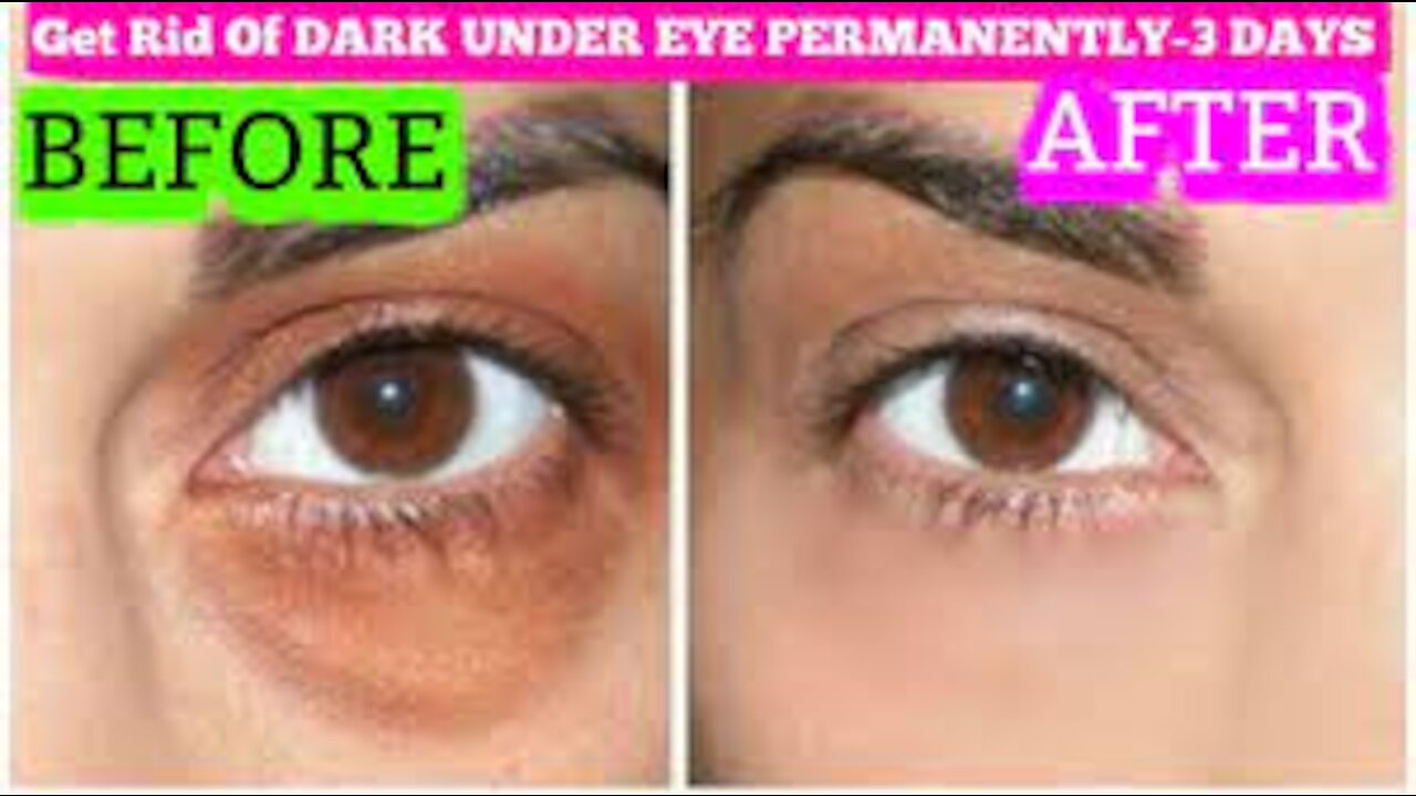 Tricks To Get Rid Of Dark Circle-How To Remove Dark Circles