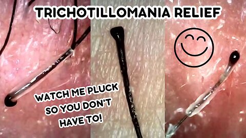 TRICHOTILLOMANIA RELIEF - Juicy BIG Hair Follicle Plucks Under the Microscope! Super Satisfying!