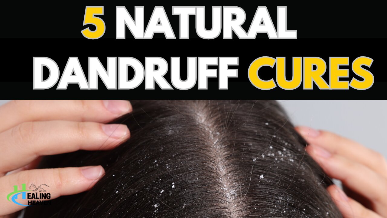 5 Natural Dandruff Cures-EASY!