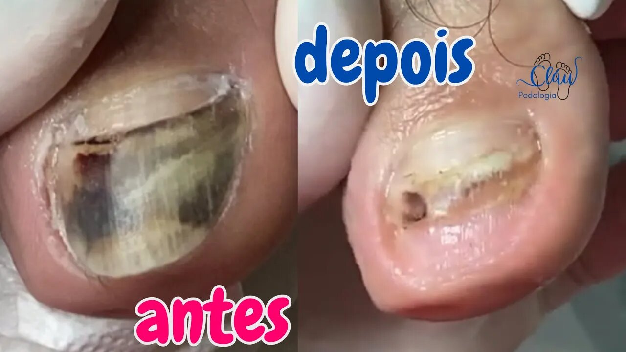 Unhas soltando? Saiba como resolver! #unhas #pes #dor #podologia #unhaencravada #profissional