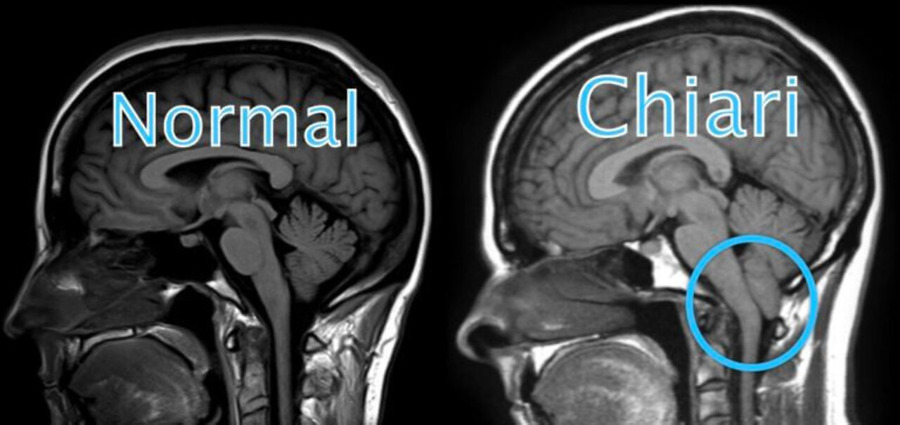 Rabbit Hole Radio - Popeye Has Chiari & CCI