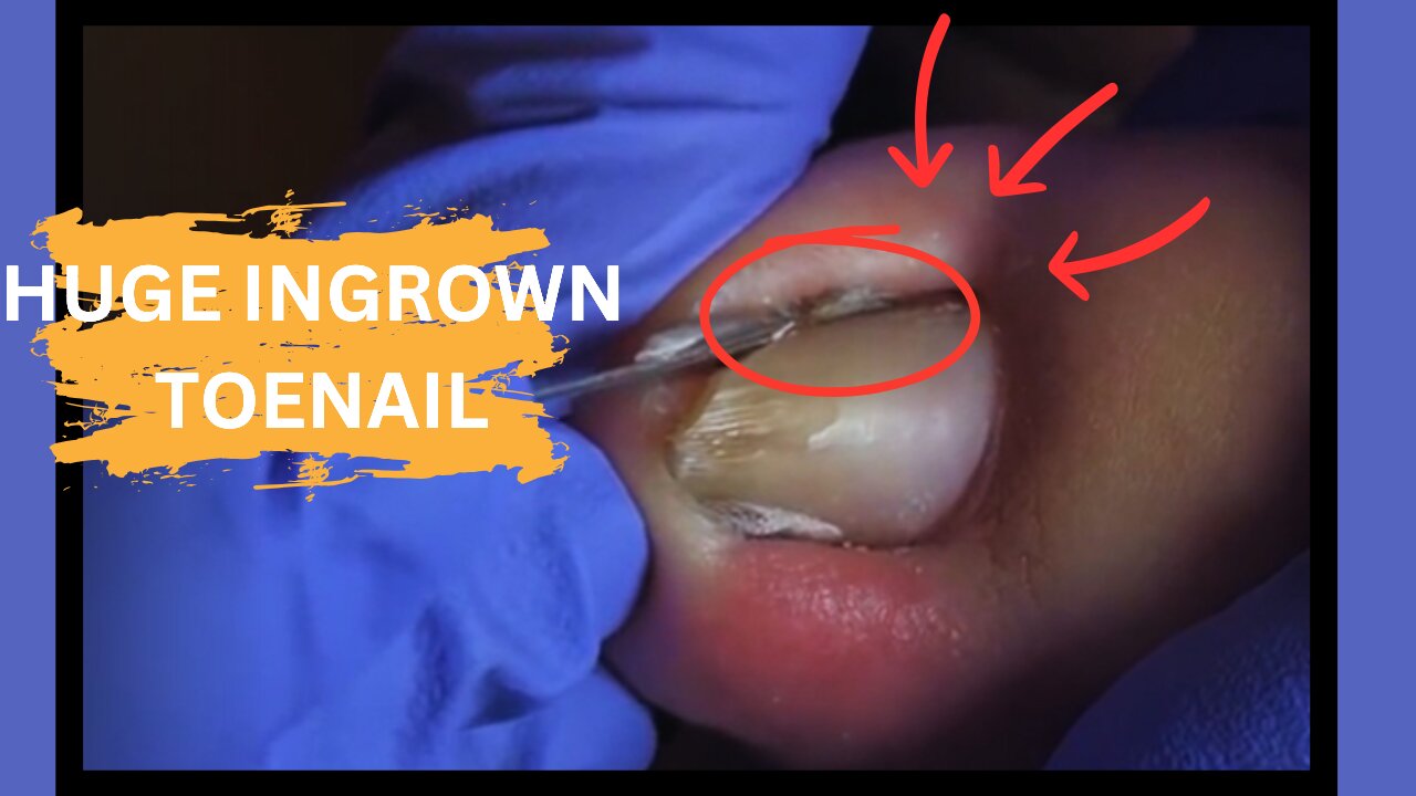 Huge ingrown toenail removal