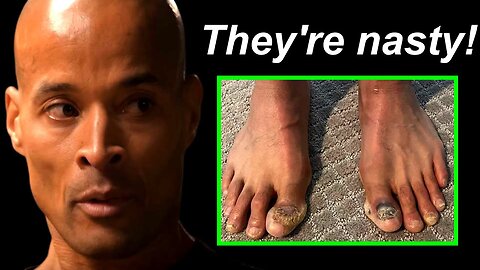 David Goggins Talks About His Messed Up Feet