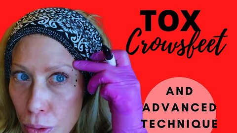 How to Tox Crows feet & Advanced Technique for STUBBORN lines