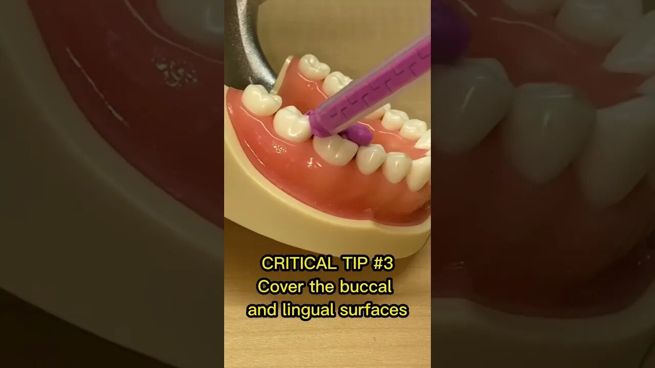 3 Tips for a Temp Crown Stent / Matrix