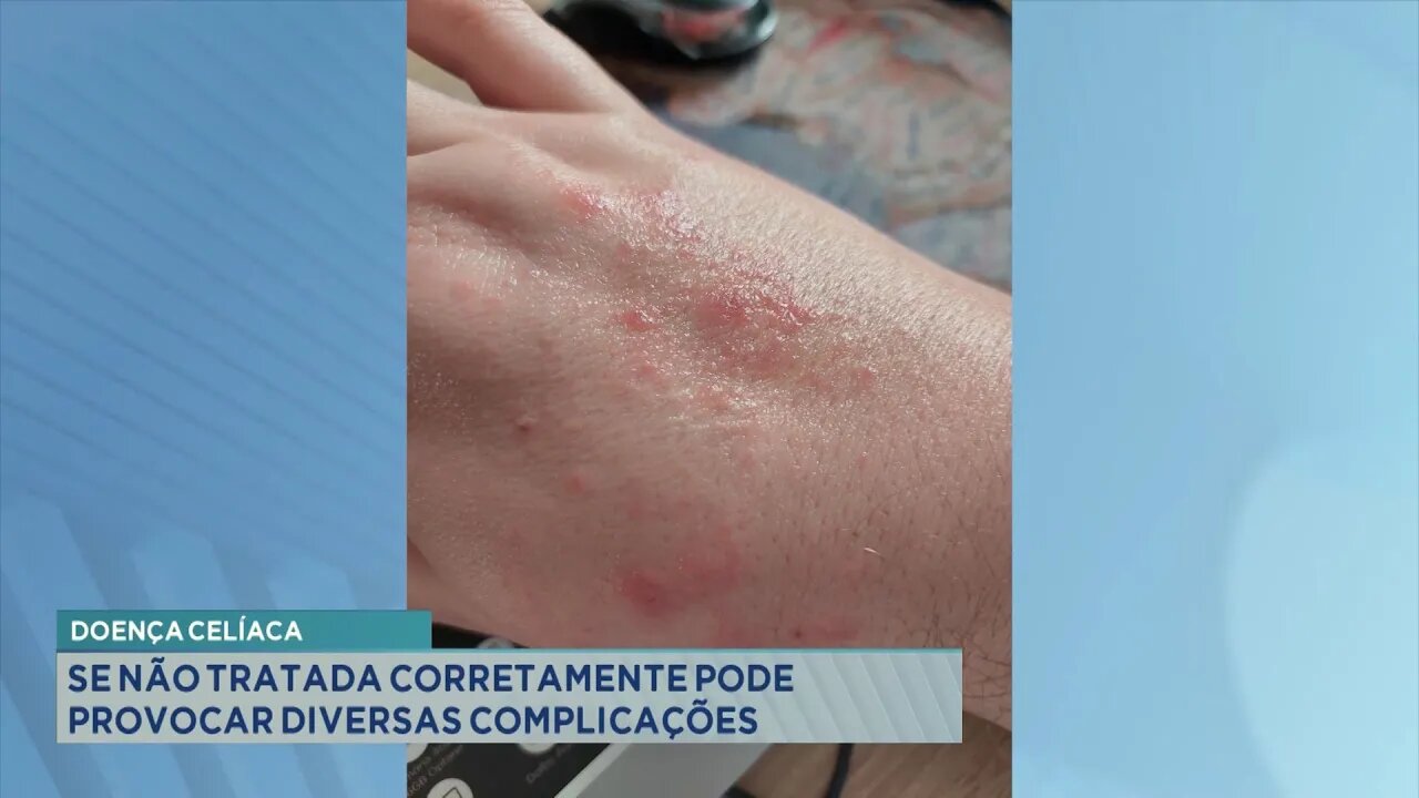 Doença Celíaca: Se não Tratada Corretamente pode Provocar diversas Complicações.