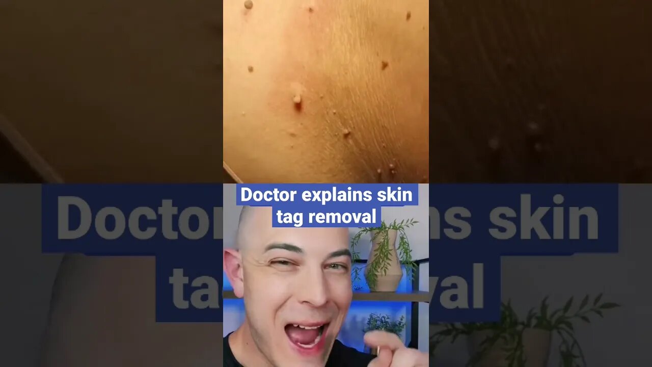 Doctor explains interesting skin tag removal!