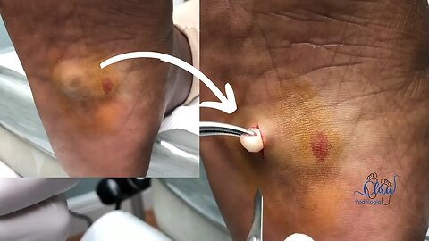 Retirada de CORPO ESTRANHO dentro da sola do PÉ!? #pes #dor #podologia #profissional #procedimento