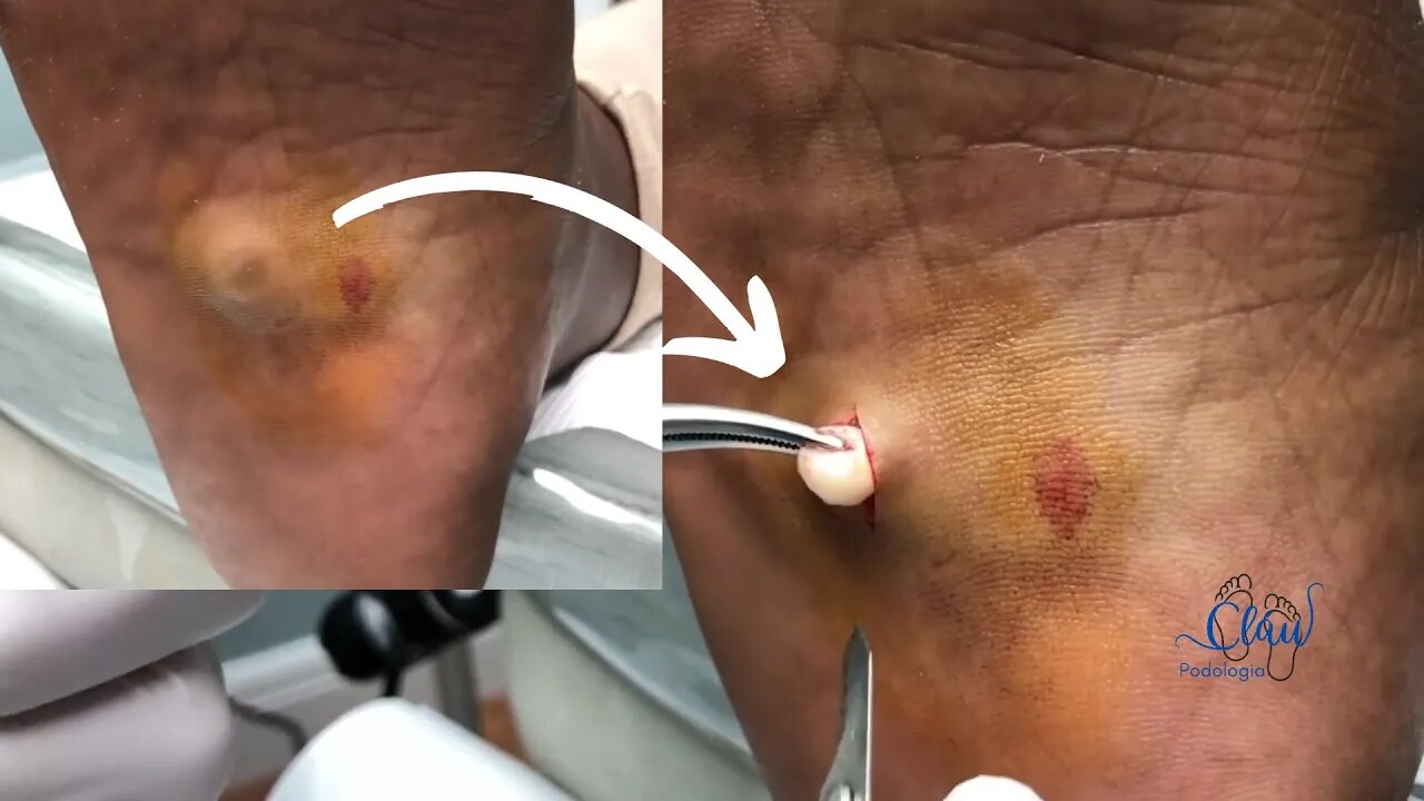 Retirada de CORPO ESTRANHO dentro da sola do PÉ!? #pes #dor #podologia #profissional #procedimento