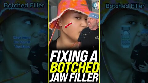 Shocking Botched Jaw Filler Result 😱 #shorts