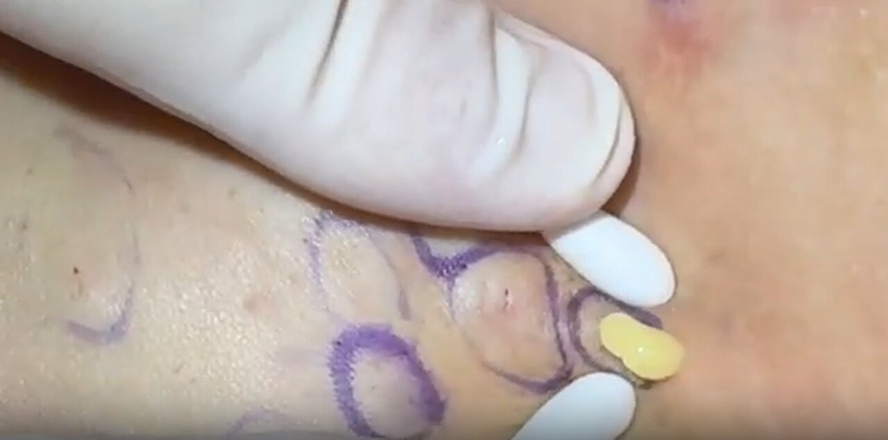 EP7 more Steatocystomas of clearing out butter with sacs