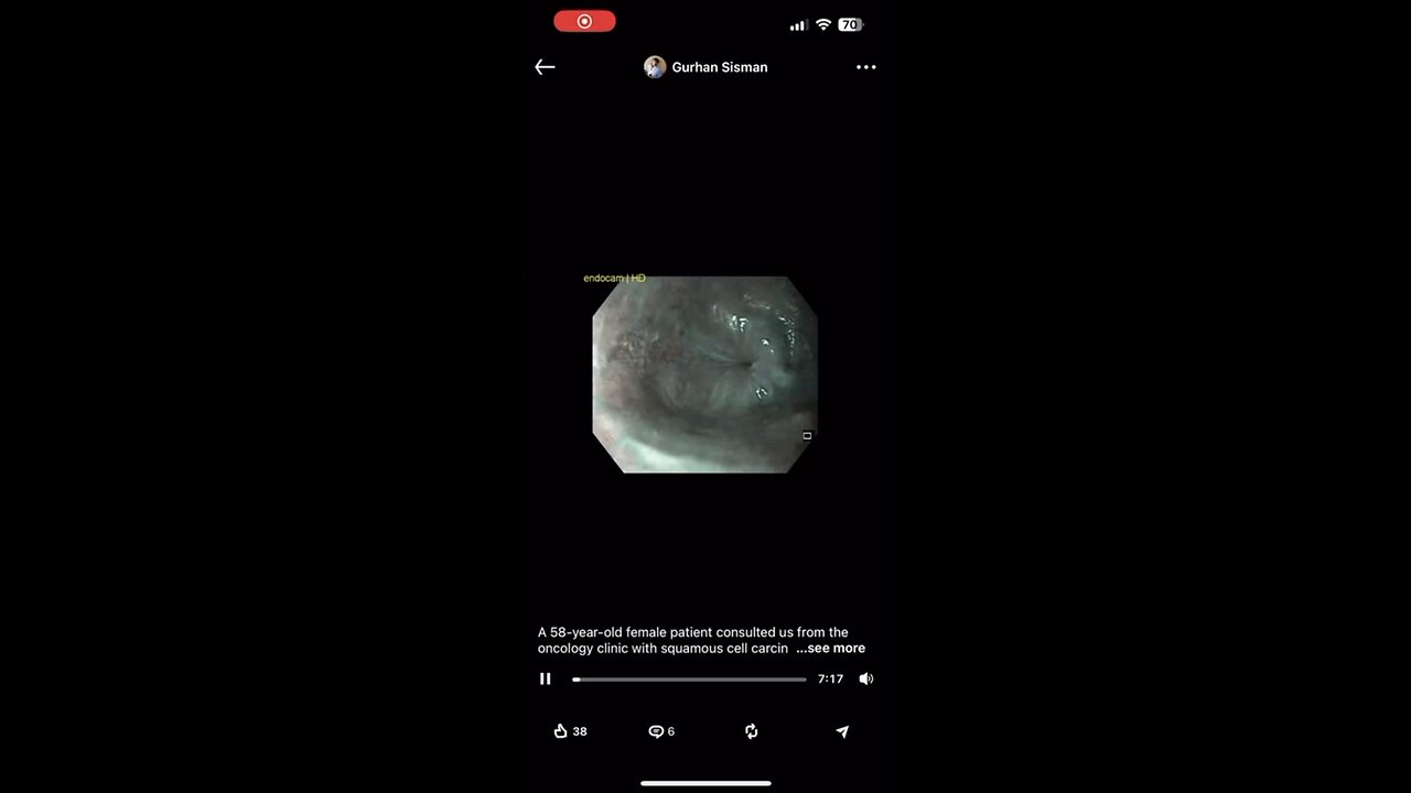 SquamousCellCarcinoma Esophageal Cancer