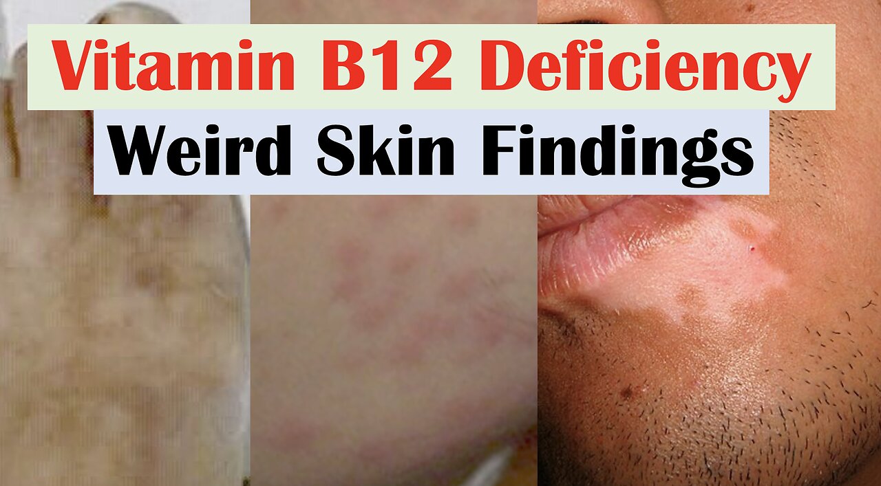 Vitamin B12 Deficiency Weird Skin Findings (& Hair and Nails)