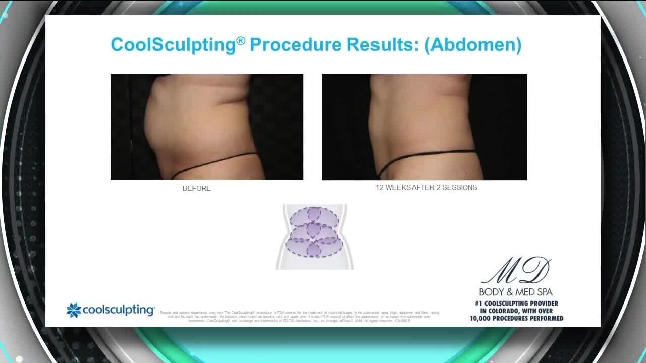 Lipo Laser For Better Fat Loss // MD Body & Med Spa