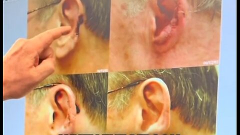 Plastic surgeon wants to fix Trump‘s ear