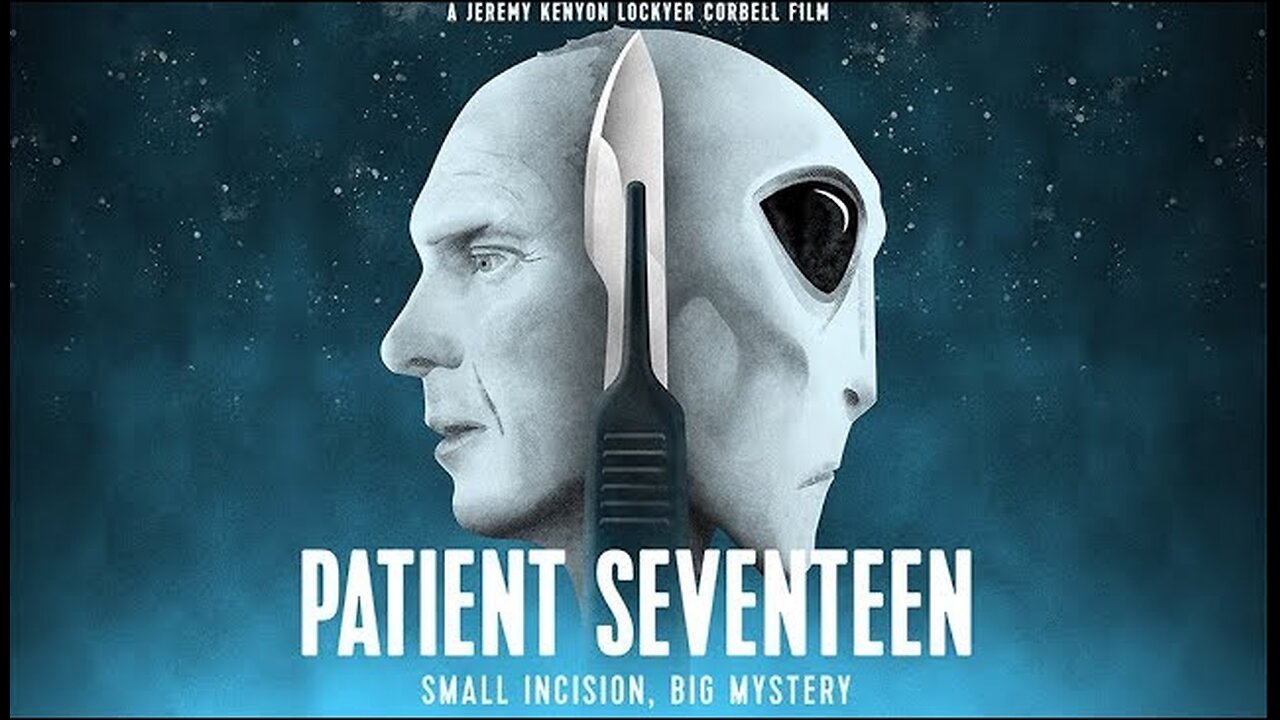 Patient Seventeen Documentary - Alien Implant Removal by Dr.Roger Leer