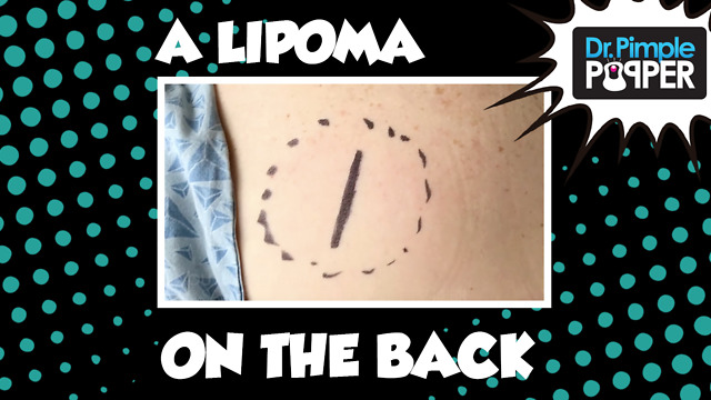 A Lipoma That Likes its Home...