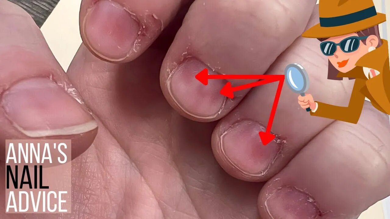 What are these red patches on the nails?! [Anna's Nail Advice]