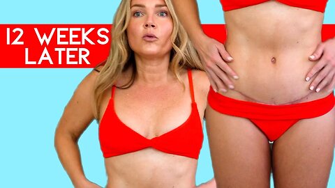 12 Week Post Mommy Makeover Tummy Tuck & Breast Lift Scar Check