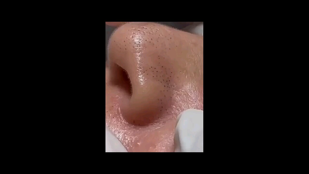 Blackheads episode 25