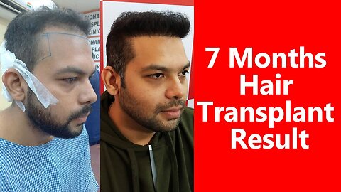 7 Month Hair Transplant Result