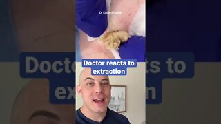 Doctor reacts to amazing extraction!!