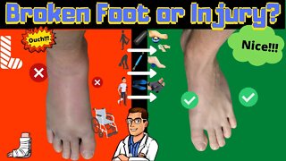 [25 MUST DO Recovery Tips]: Broken Foot | Sprain | Stress Fracture